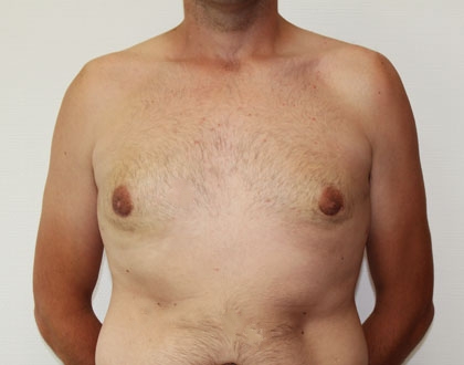 ginekomastia-po