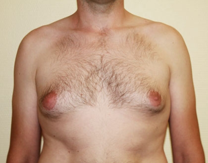 Ginekomastia - przed zabiegiem